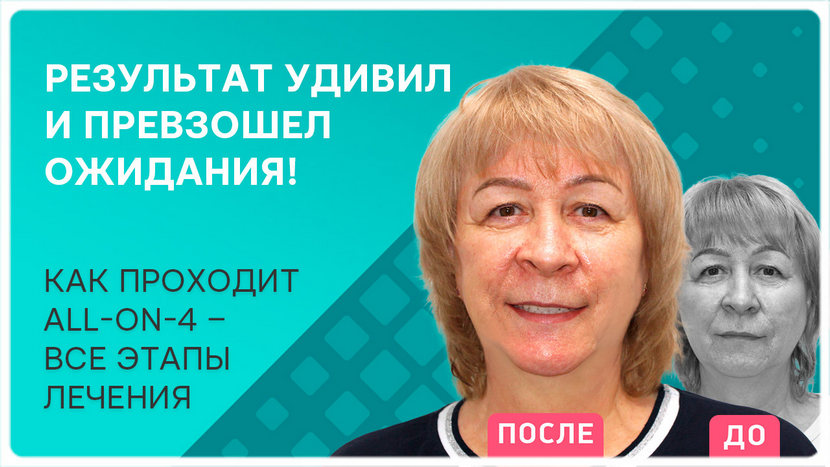 Видеоотзыв Имамовой Риммы после имплантации всех зубов