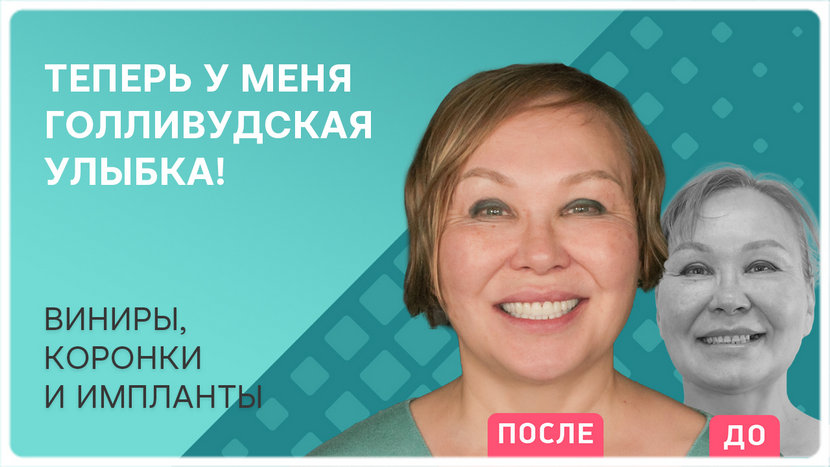 Видео после имплантация зубов Straumann и виниры