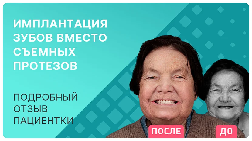 Видео-отзыв после имплантации зубов в 76 лет