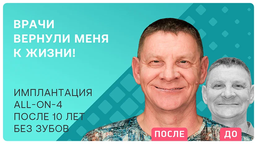 Видео отзыв про имплантацию зубов All-on-4 после 10 лет без зубов