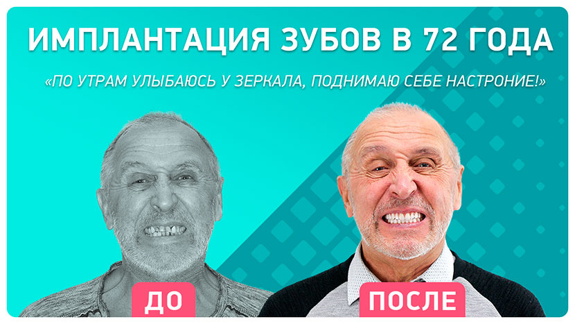 Видео-отзыв через 1 год после комплексной имплантации
