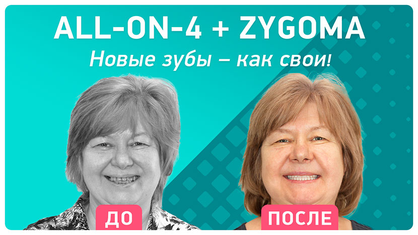 Видео-отзыв через 6 месяцев после имплантации