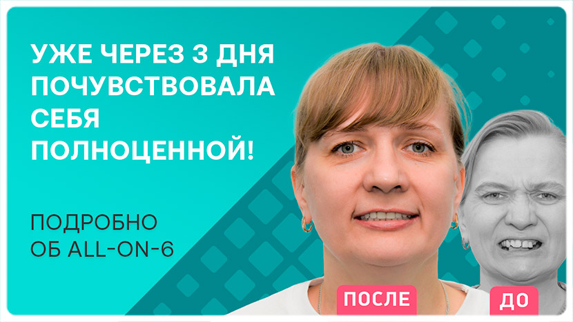 Видео после имплантации зубов all-on-6