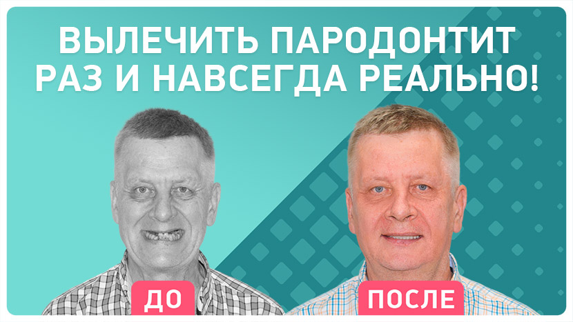 Видео отзыв после имплантации все на 4