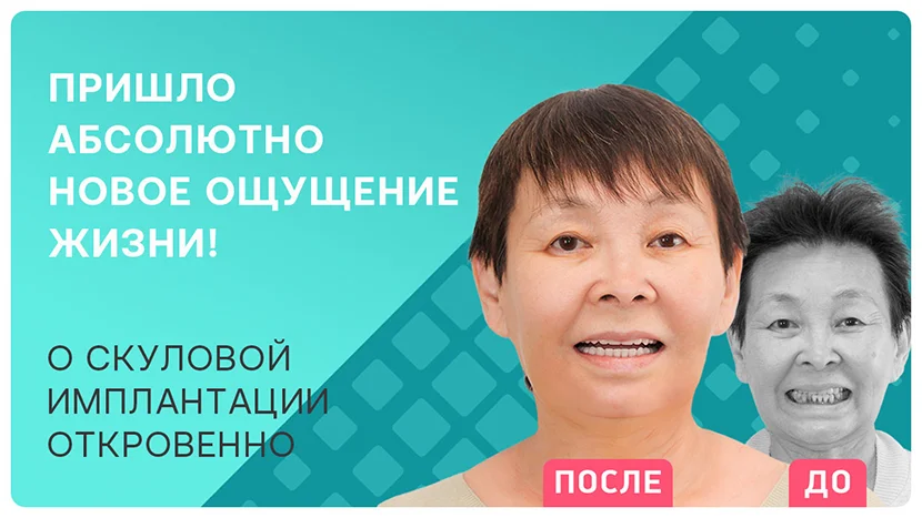 Видео отзыв после имплантации all-on-4 и all-on-6