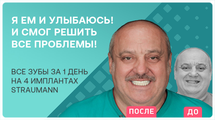 Видео об имплантации зубов на 4 имплантах Straumann