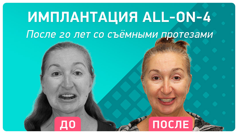 Видео-отзыв пациентки после имплантации зубов