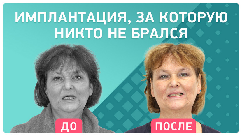 Отзыв через 6 месяцев после All-on-6