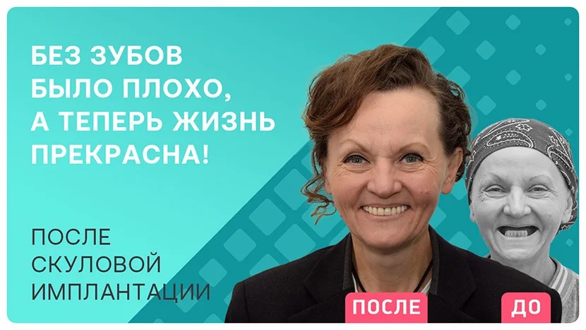 Видео-отзыв после скуловой имплантации All-on-4 Nobel Zygoma