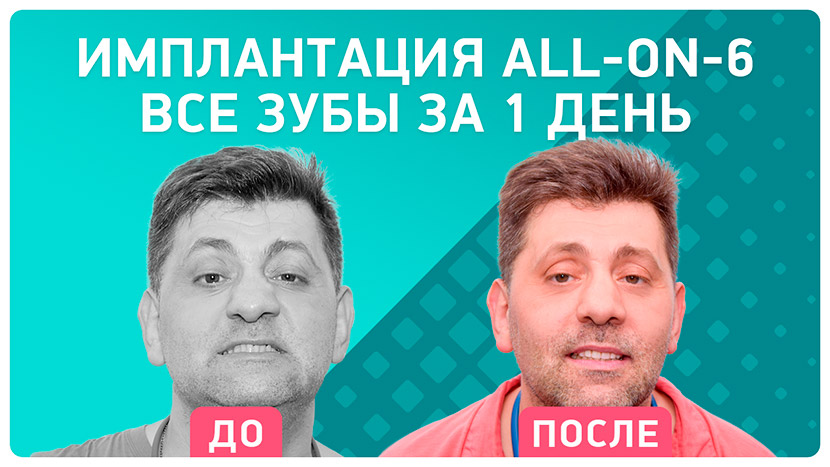Видео-отзыв после имплантации all-on-6