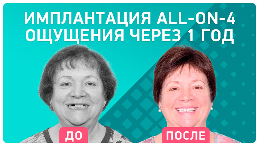 Видео отзыв после имплантации зубы за 1 день