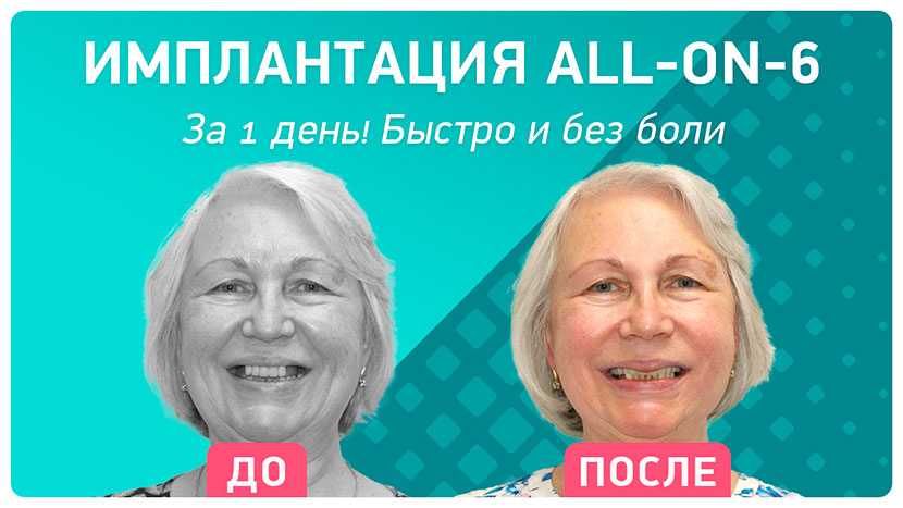 Видео-отзыв сразу после имплантации зубов
