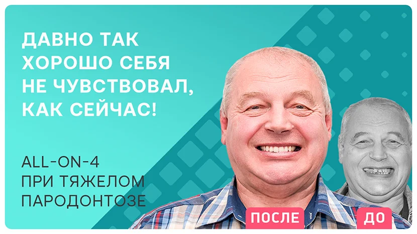 Видео отзыв после протезирования All-on-4