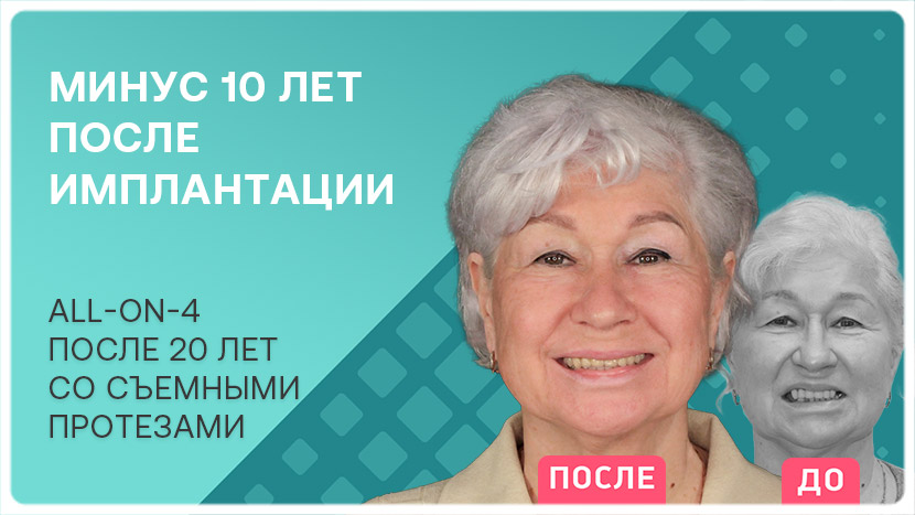 Видео отзыв пациентки после имплантации all-on-4