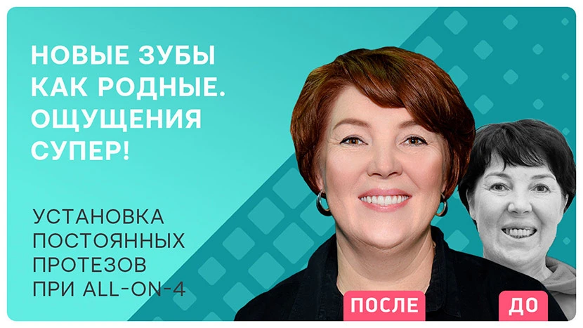 Как проходит перепротезирование при all-on-4