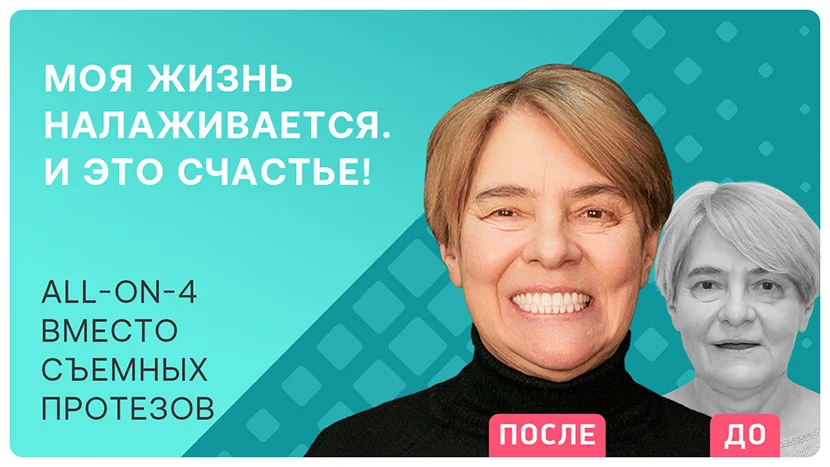Видео-отзыв о сложном восстановлении всех зубов all-on-4