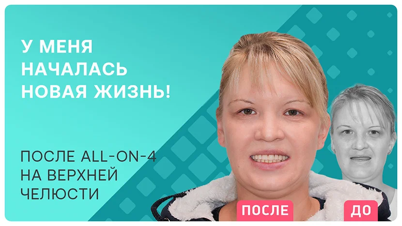 Видео отзыв о новой жизни с красивой улыбкой после all-on-4
