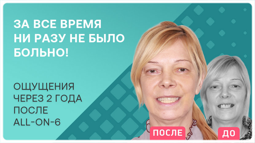 Видео через 2 года после имплантации all-on-6