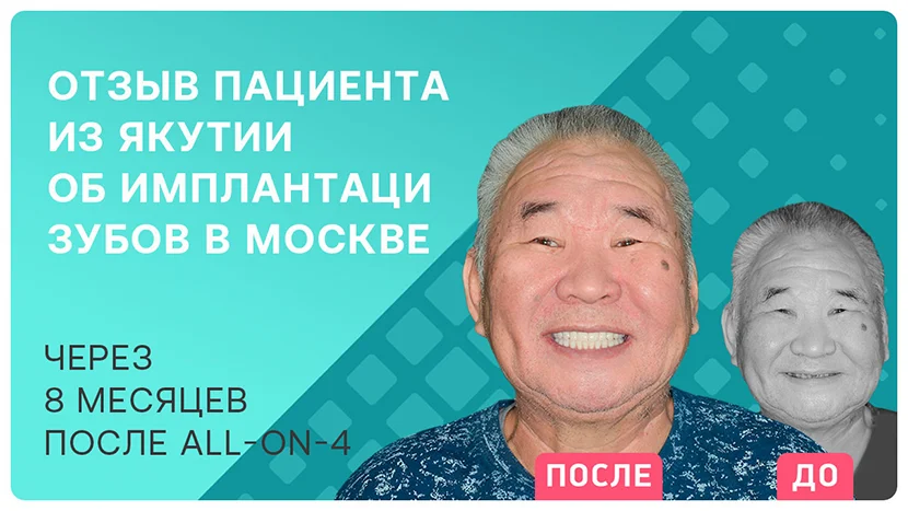 Видео-отзыв через 8 месяцев после имплантации ALL-ON-4