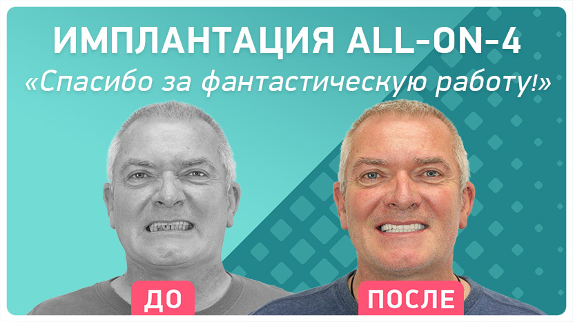 Видео-отзыв после имплантации all-on-4