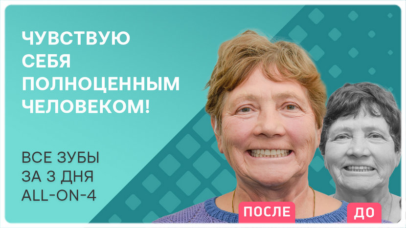 Видео после проведения имплантации зубов All-on-4