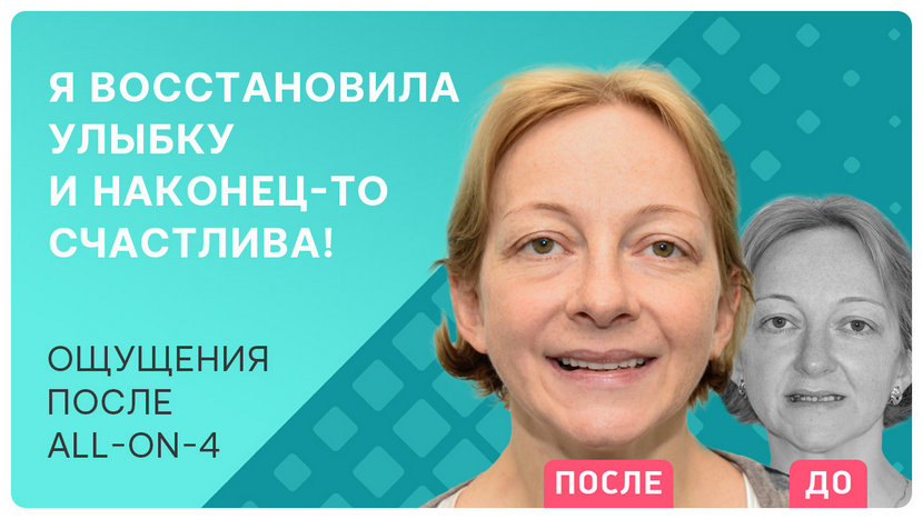 Видео через месяц после имплантации зубов All on 4