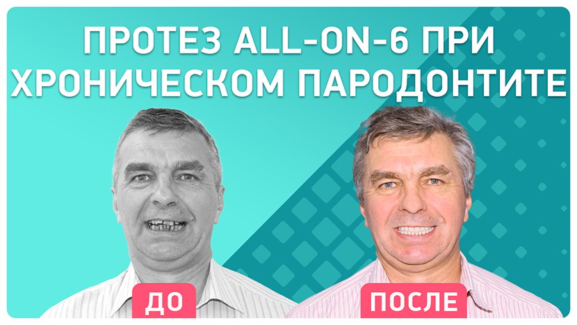 Видео-отзыв протезирование all-on-6