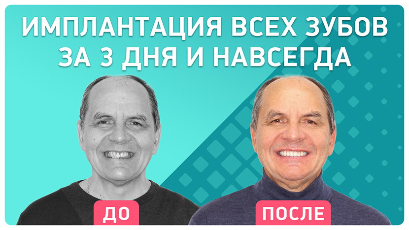 Видео-отзыв полное восстановление зубов при помощи комплексной имплантации