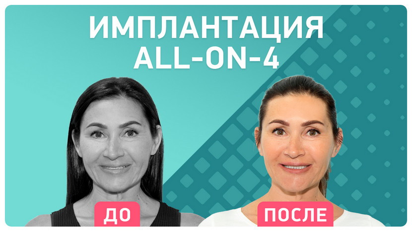 Видео-отзыв имплантация all-on-4