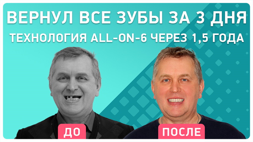 Видео-отзыв через полтора года после имплантации