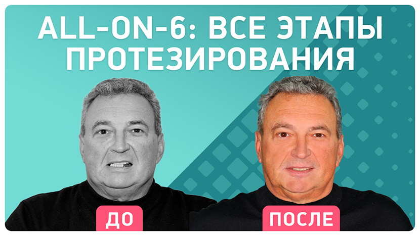 Видео-отзыв All-on-6: все этапы протезирования