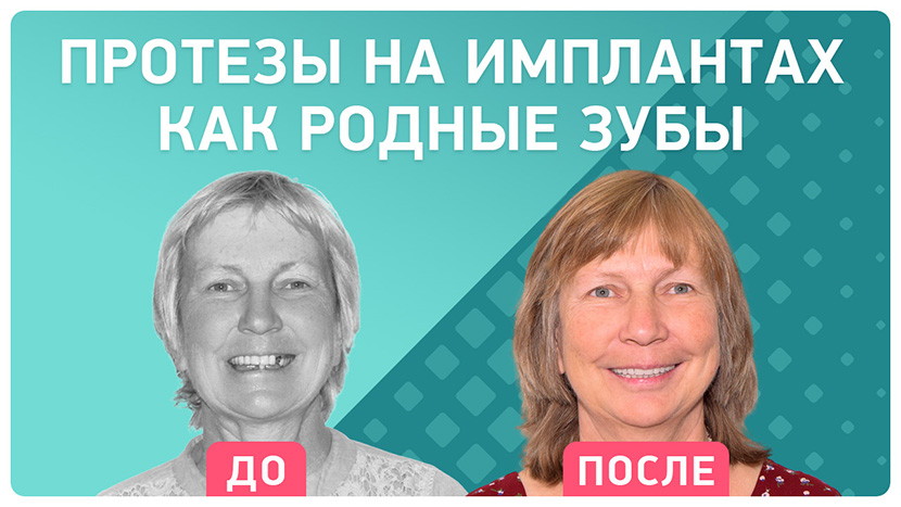 Видео-отзыв после имплантации нижних зубов