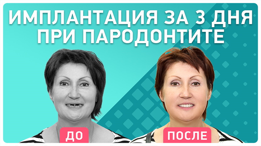 Видео-отзыв имплантация за три дня при пародонтите