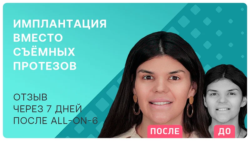 Видео-отзыв после имплантации всех зубов all-on-6