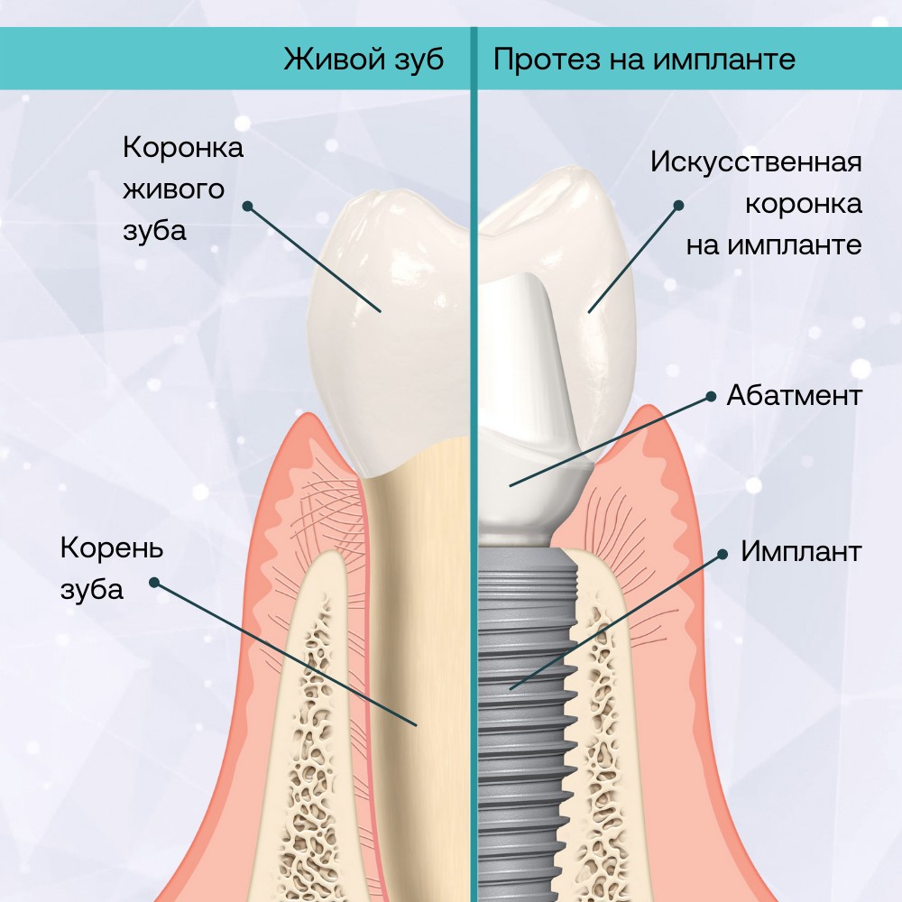 протез на импланте и живой зуб