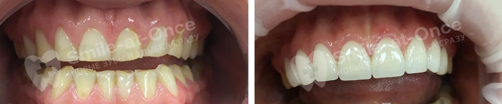 до и после установки виниров на зубы