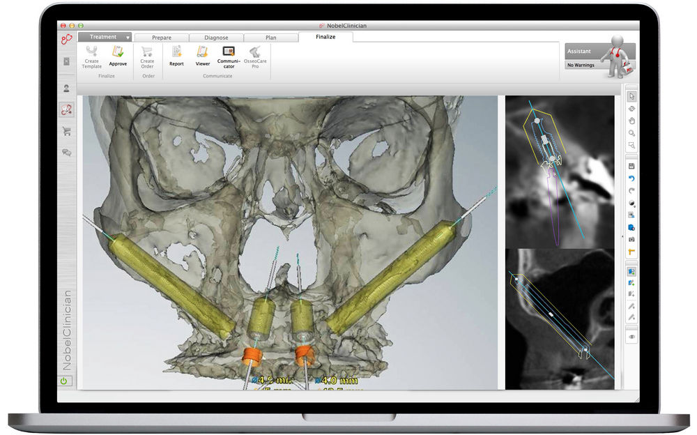 Визуализация модели челюсти в программе Nobel Clinician