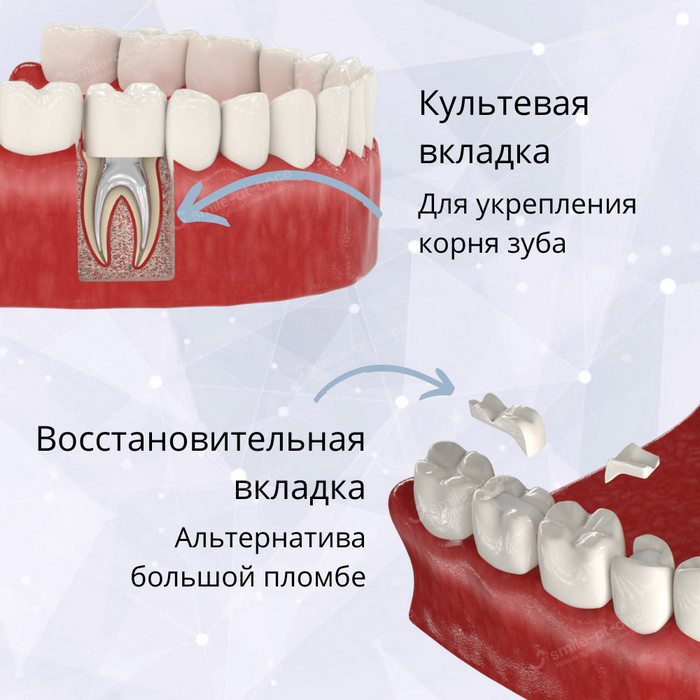 Восстановительная или культевая вкладка