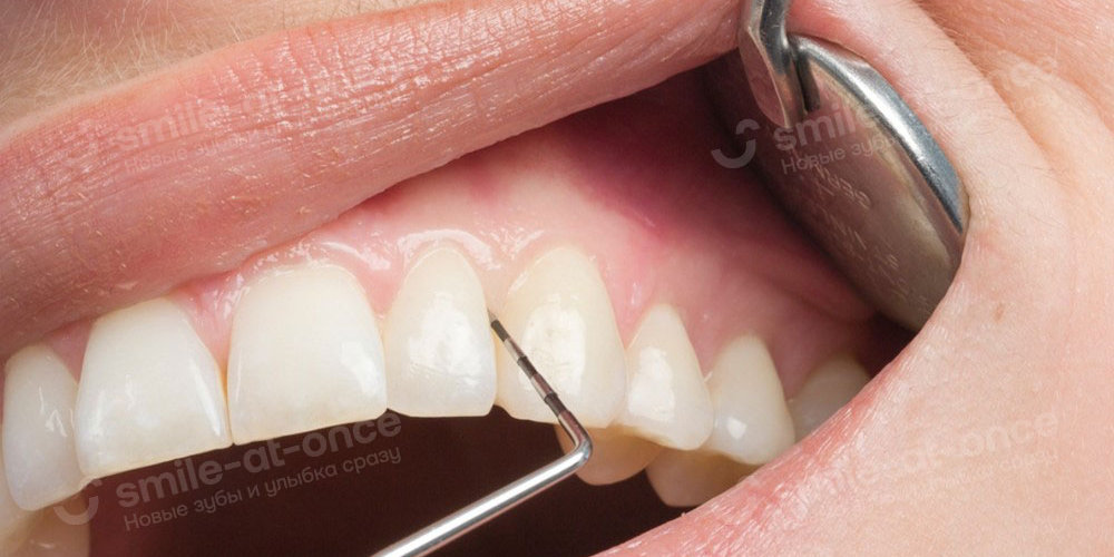 Что такое флюс зуба?
