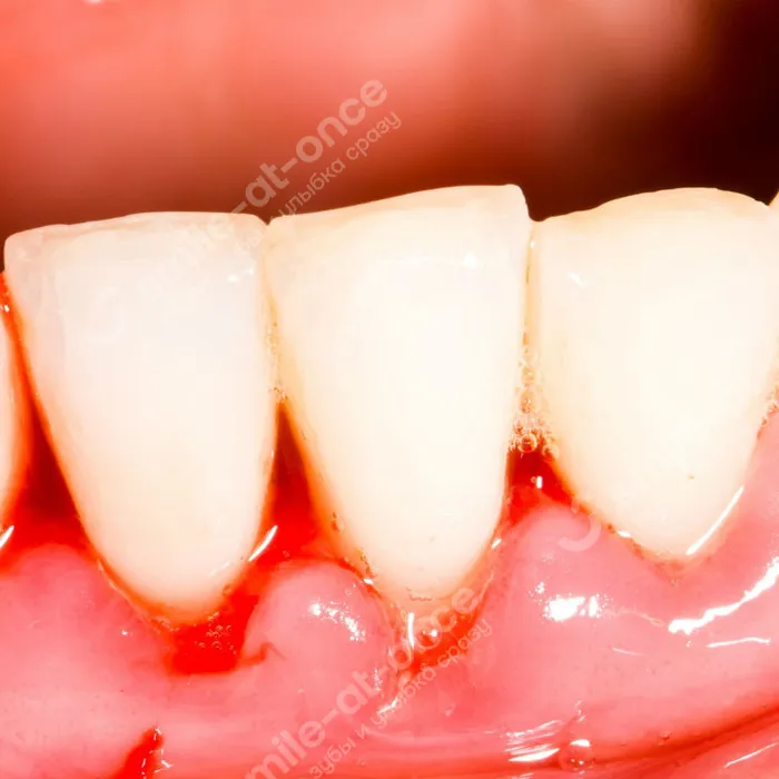 Оголение шейки зуба – причины, лечение.