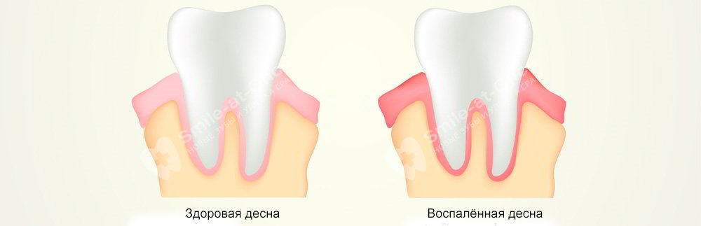 Как определить заболевание гингивитом? Развитие гингивита