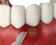 Удаление кисты или гранулемы зуба