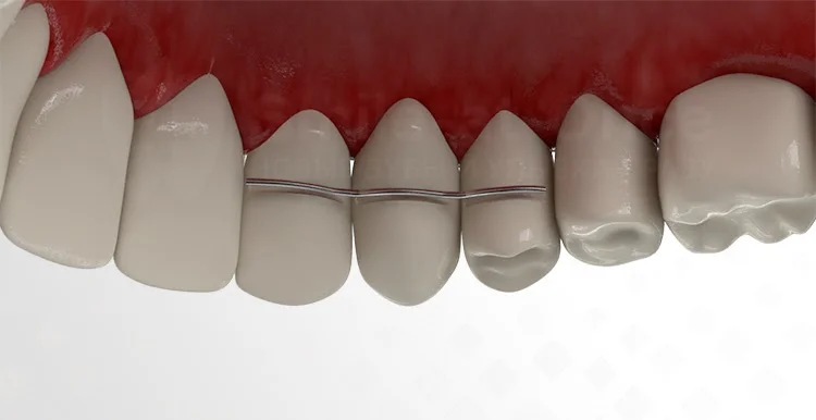 Что делать с реплантированным зубом