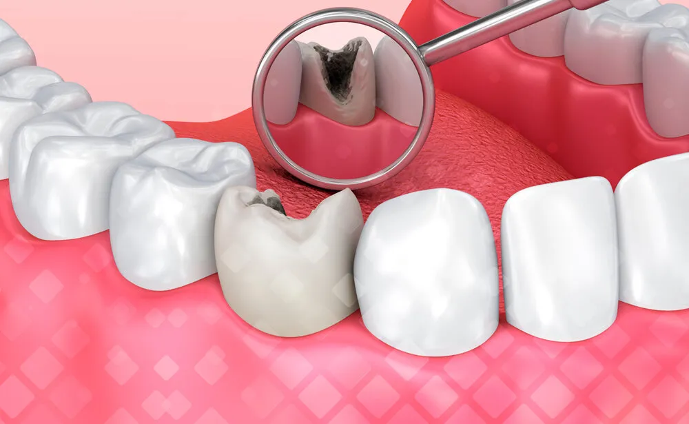 выпадение пломбы из зуба
