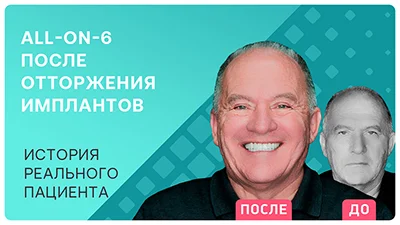 Видео - Протезирование All-on-6 после отторжения имплантов