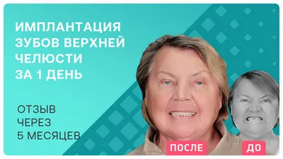 Видео - Все зубы на имплантах за 1 день – ощущения от постоянных протезов