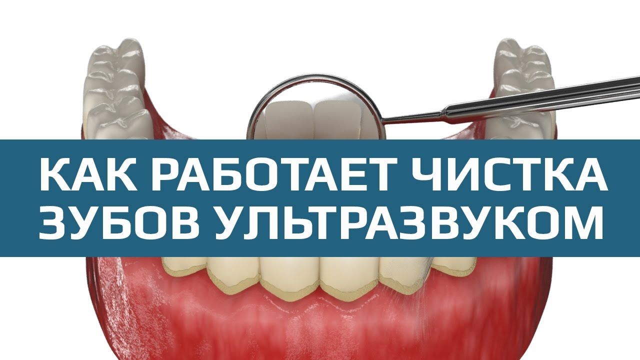 Видео о чистке зубов ультразвуком