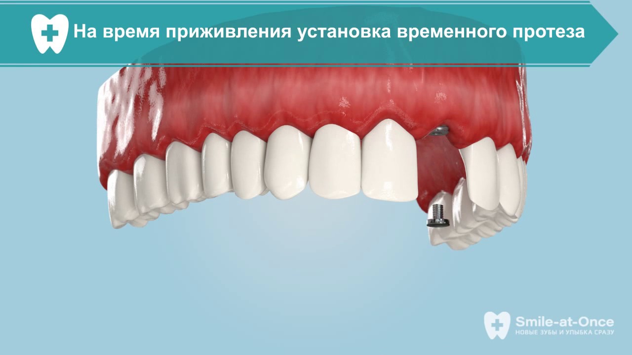 Видео одномоментная имплантация зуба