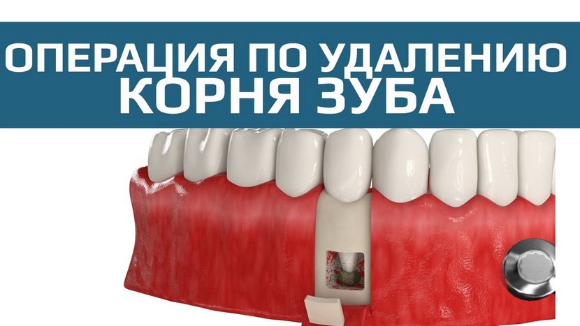 Видео о резекции корня зуба
