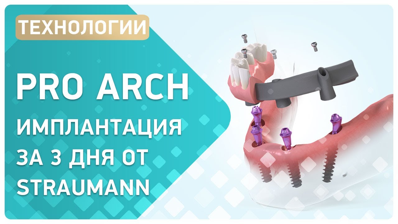 Об имплантации Pro Arch от Straumann